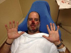 TimCo with face very injured in hospital after bike accident. 
